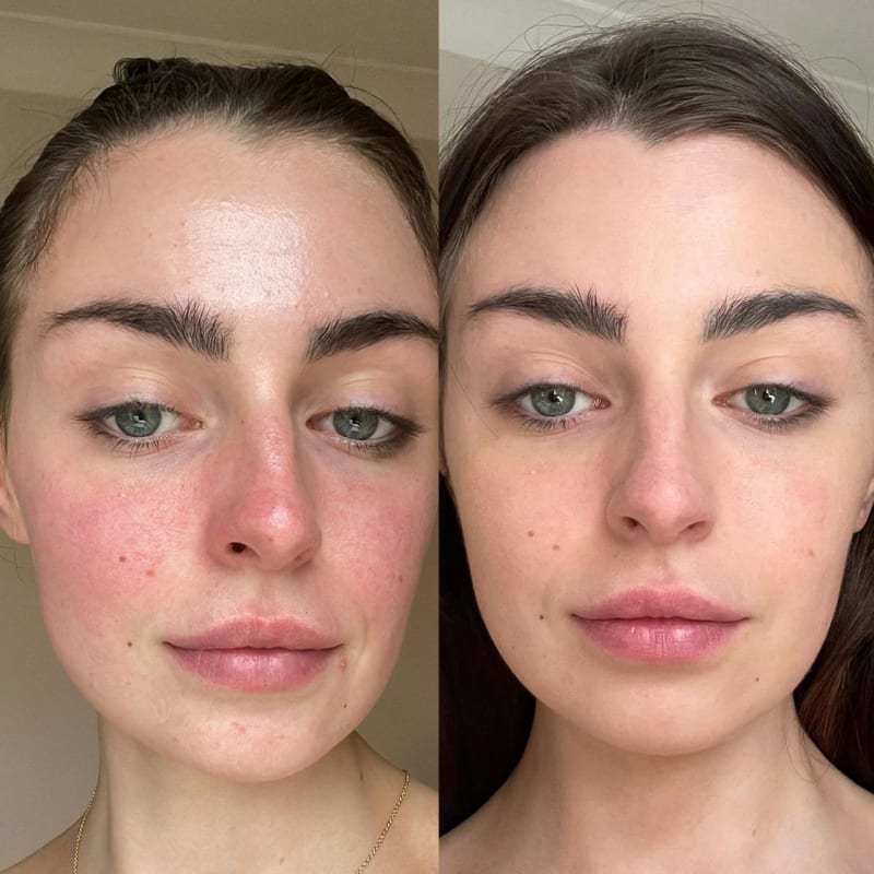 Redness & Irritation: Quick Fixes for Sensitive Skin Flare-Ups