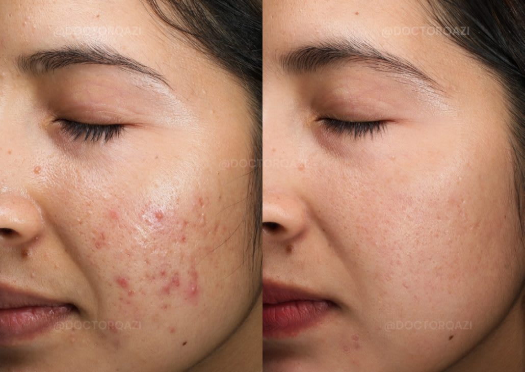 Cystic Acne Solutions: Gentle Yet Powerful Treatments