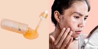 Hyperpigmentation: Causes & K-Beauty's Gentle Brightening Fix