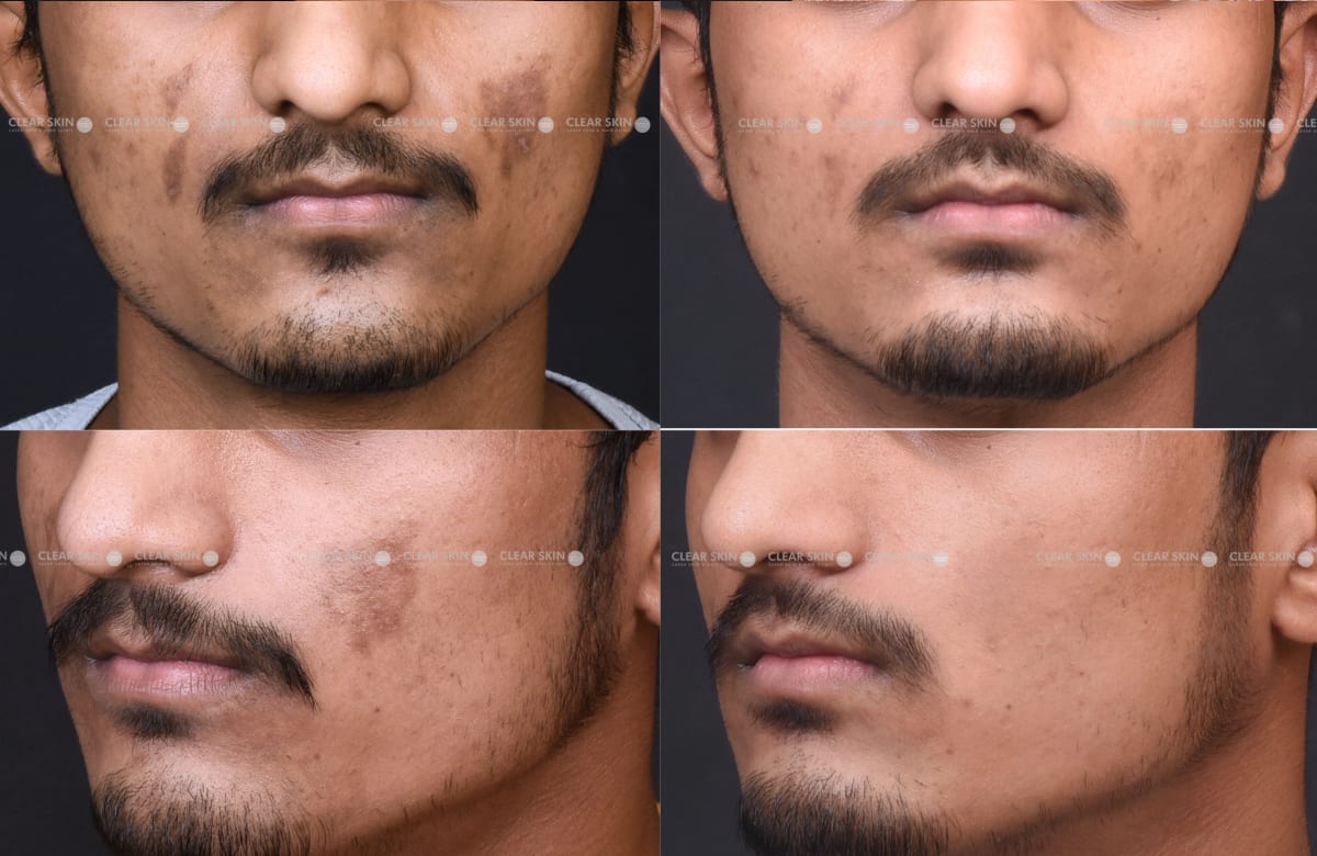 Dark Spots on Face: Men's Guide to Clearer Skin Dark Spots on Face: Men's Guide to Clearer Skin