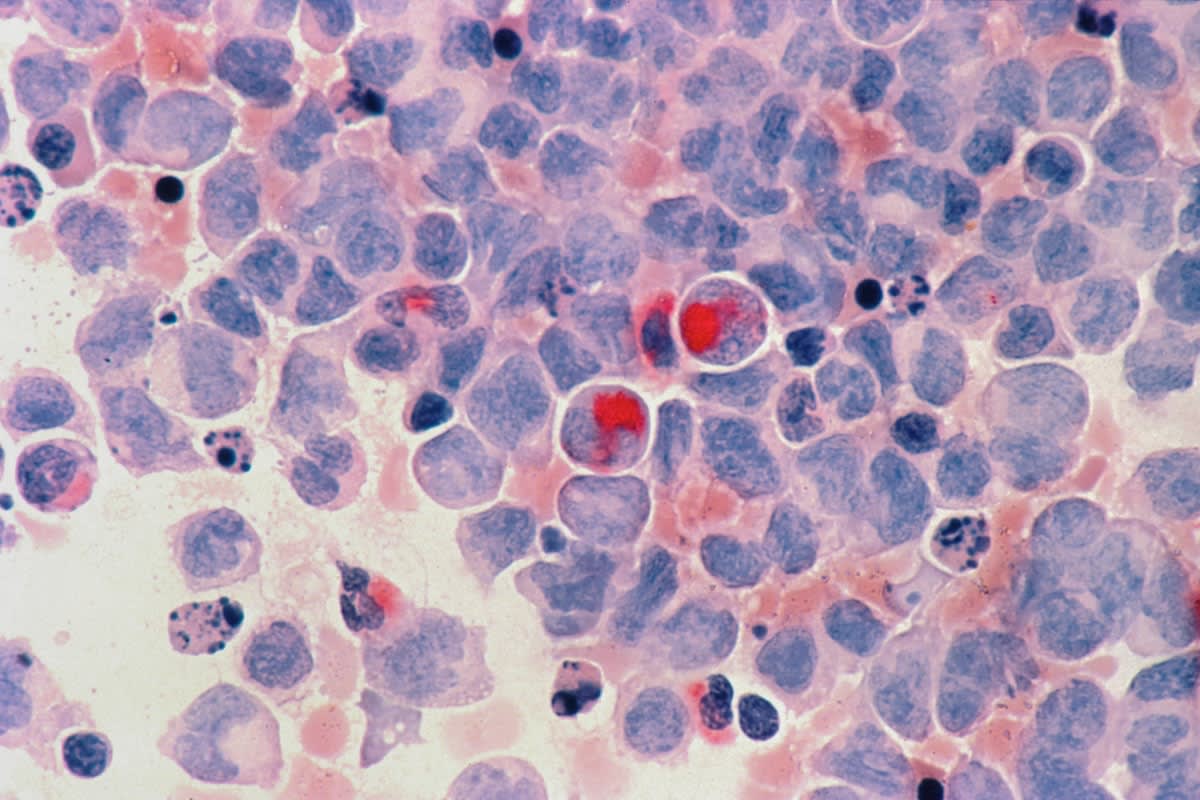 Microscopic view of cancer cells infiltrating tissue