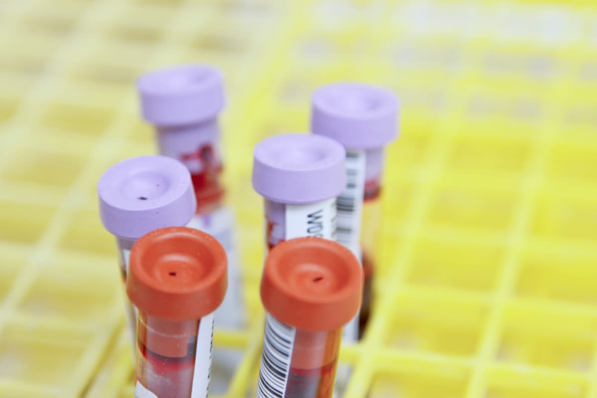 Close up of a blood sample tube with a medical label