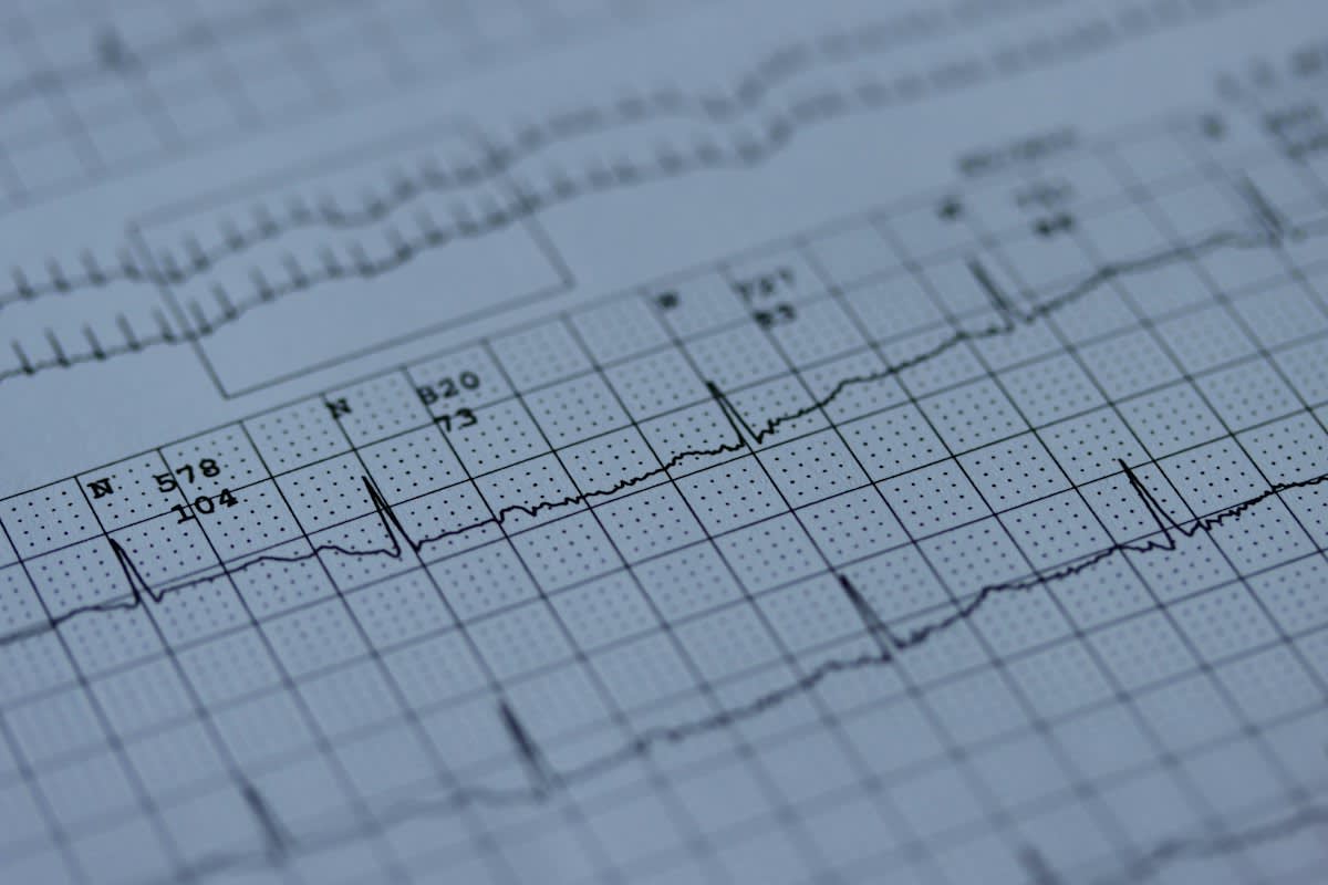 ECG rhythm showing low variability