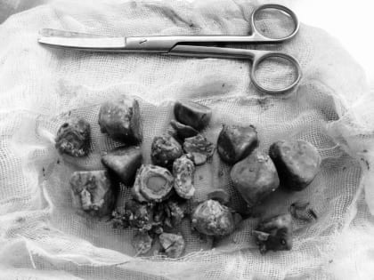 Орехово-зуевские врачи спасли пациентку — она 15 лет жила с 300 граммами камней во внутренних органах