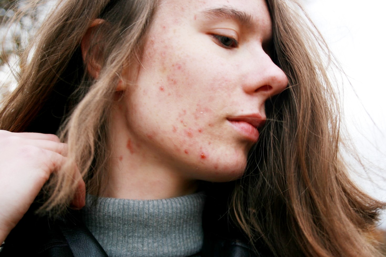 How to Deal With Acne: Self-Care Tips From the Experts