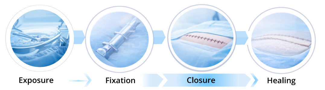 Surgical phases highlighting closure