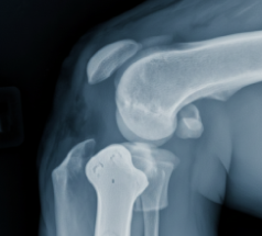 Implant-associated models