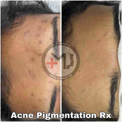 Acne Pigmentation Rx