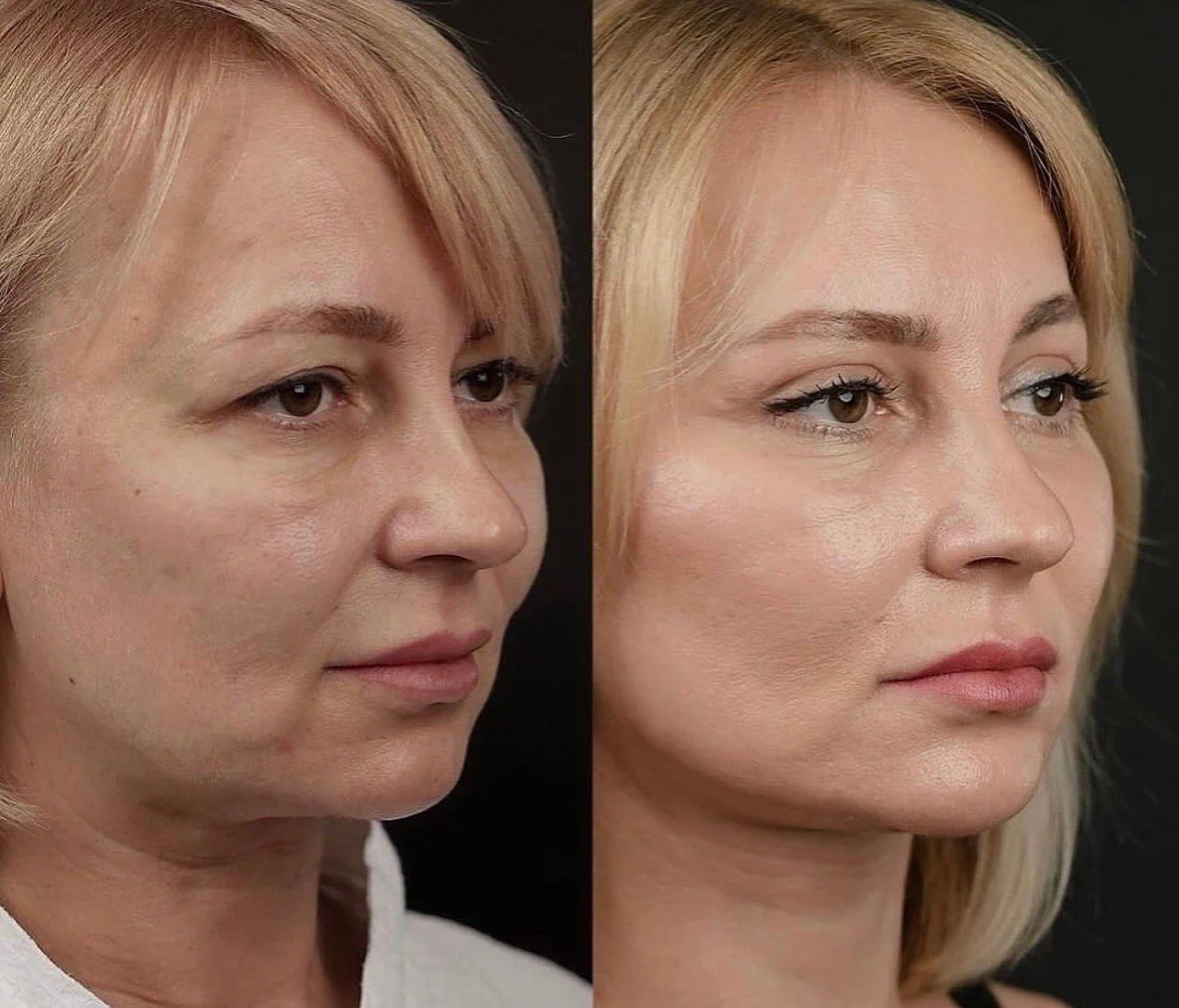 Před a po SMAS liftingu – výsledky omlazení pleti