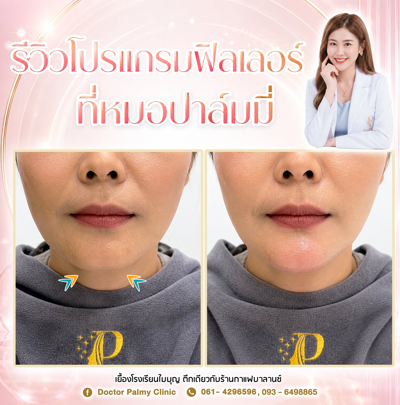 ก่อนดูแล Filler คาง1