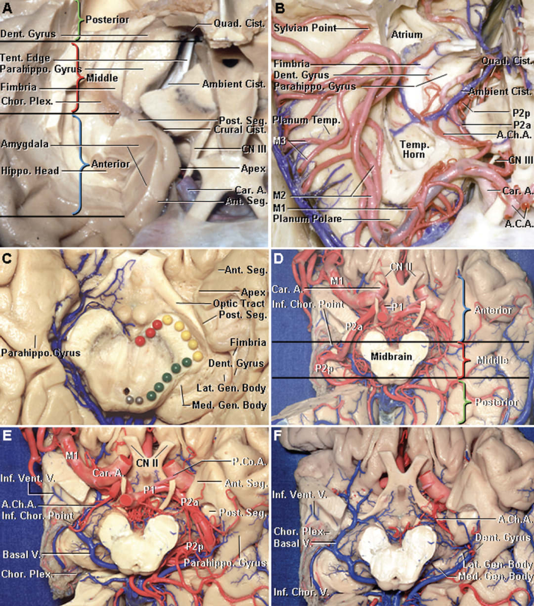 Sequential Dissection of Temporal Region | Neuroanatomy | The ...