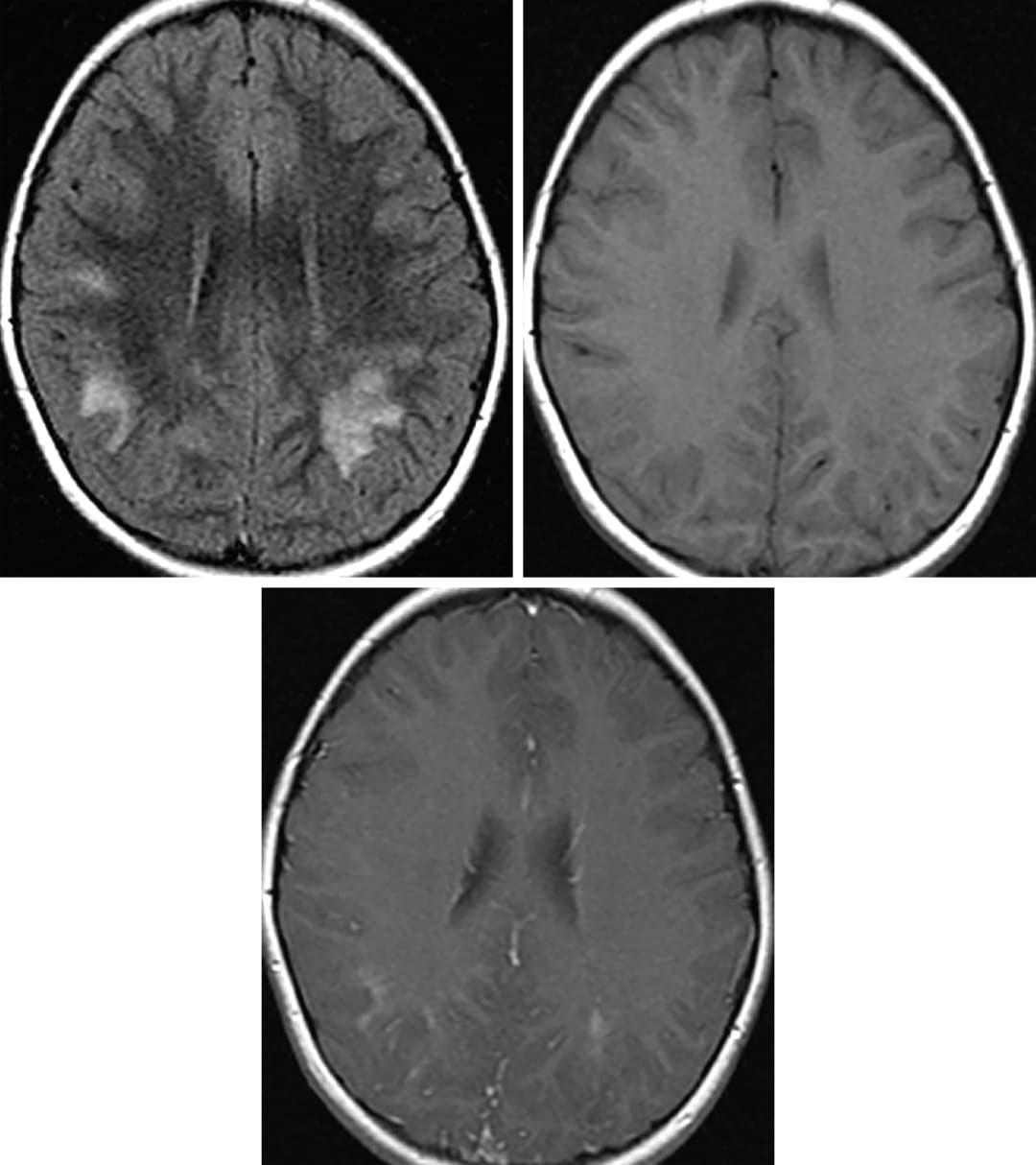 Acute Disseminated Encephalomyelitis | Cohen Collection | Volumes | The ...
