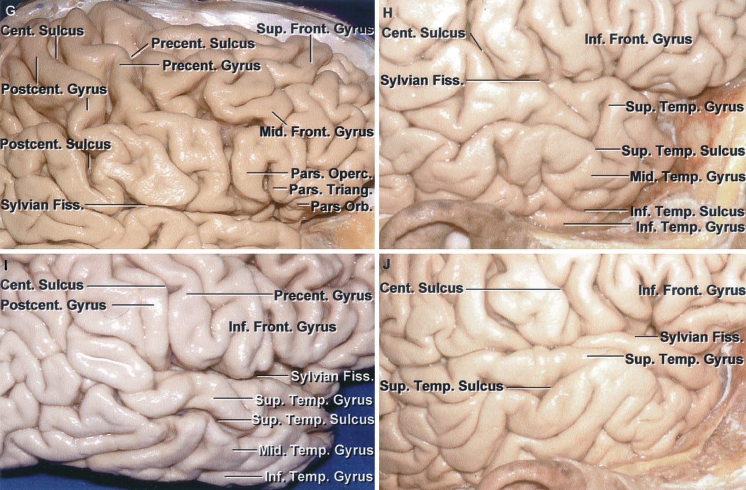 Identification of the Pre- and Postcentral Gyri and Variations in the ...