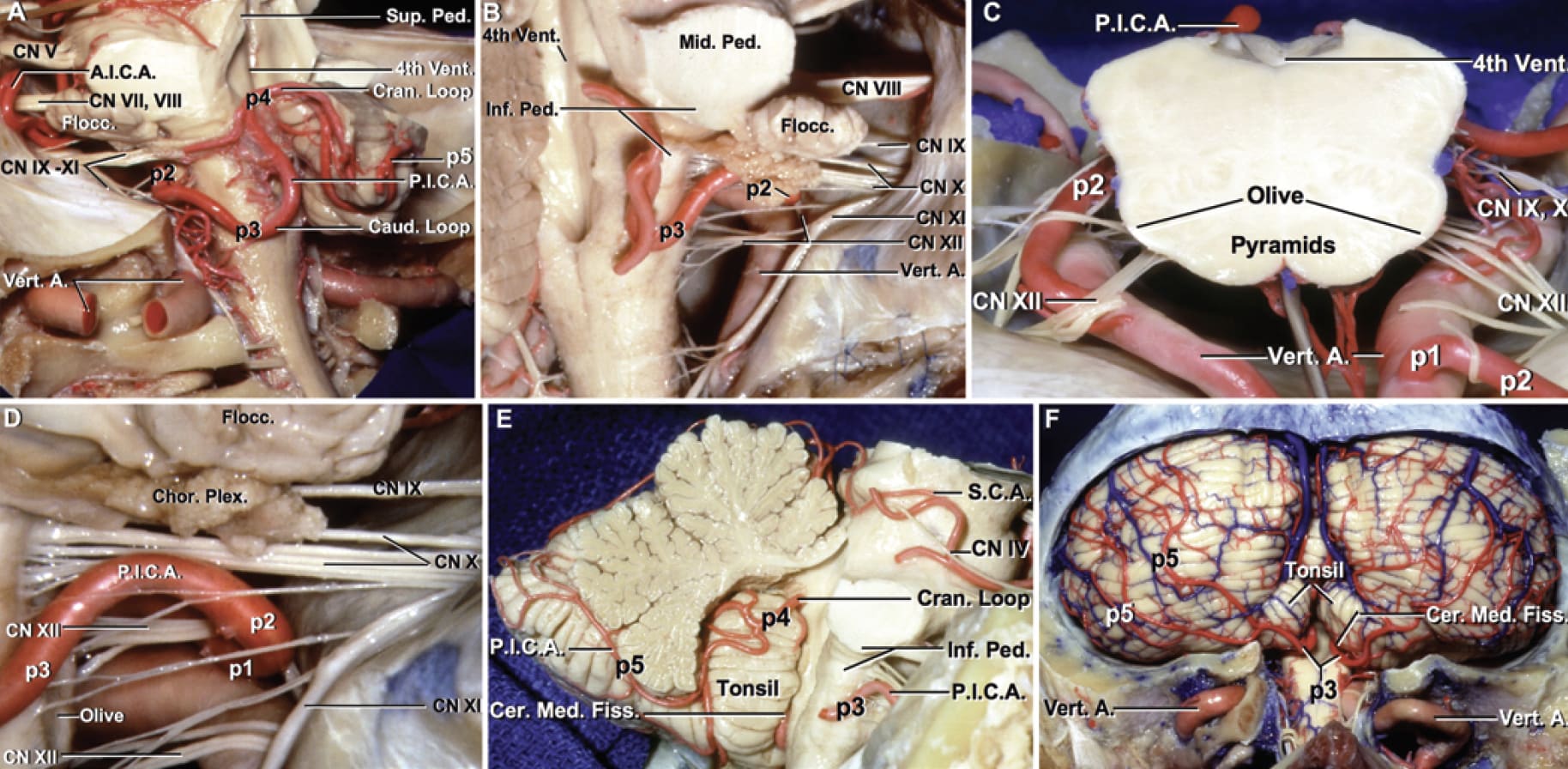 Segments of the PICA | Neuroanatomy | The Neurosurgical Atlas