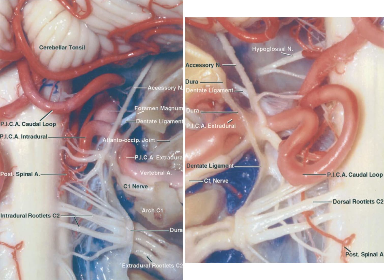 Enlarged View of the Right PICA | Neuroanatomy | The Neurosurgical Atlas