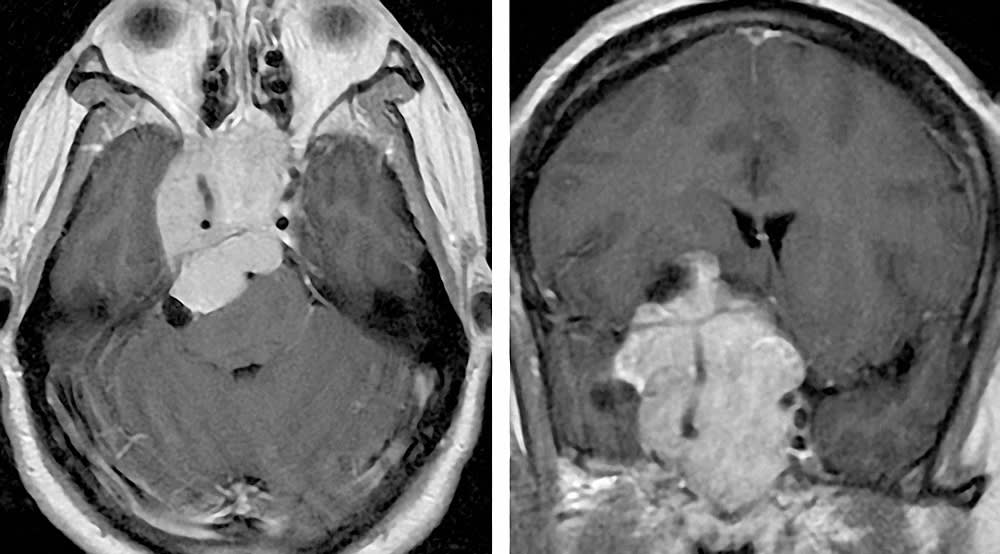 Microscope-Guided Endonasal Transsphenoidal Approach | Cohen Collection ...