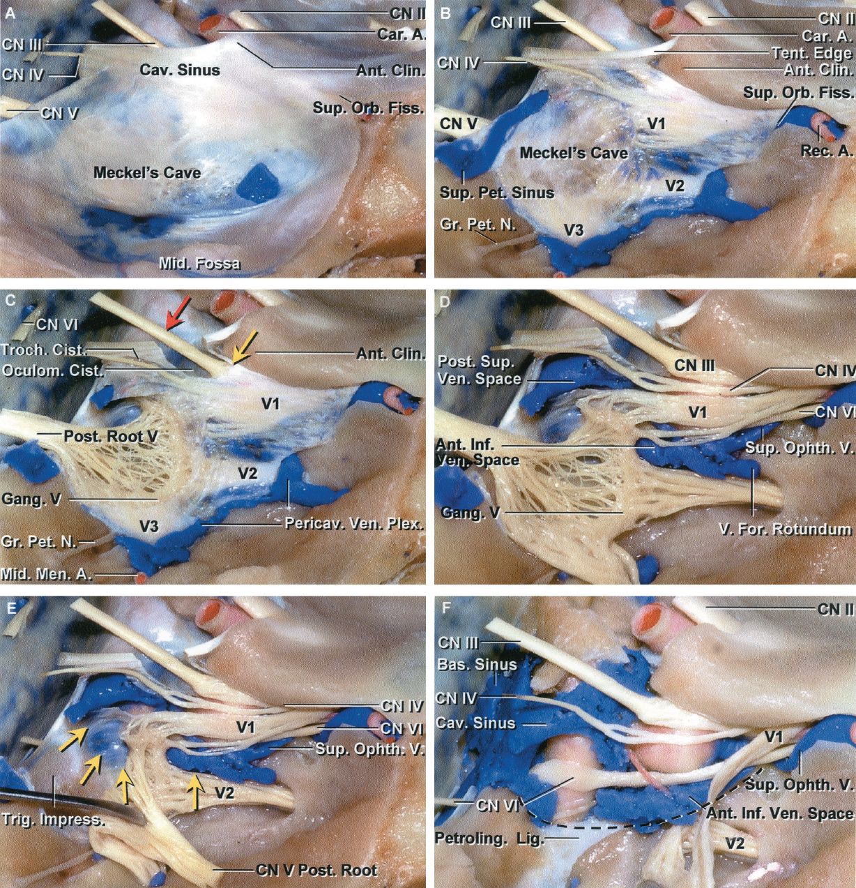 Stepwise Dissection of the Right Cavernous Sinus | Neuroanatomy