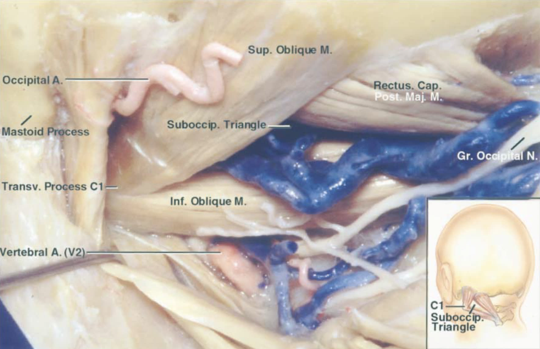 red triangular suboccipital