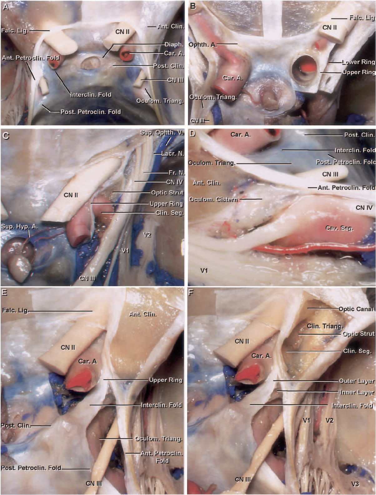 Stepwise Dissection of the Roof of the Cavernous Sinus