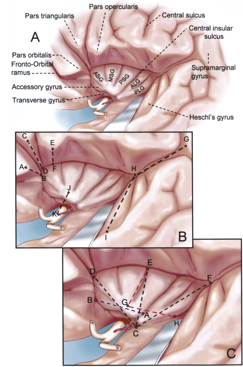 Drawings of the Lateral View of the Left Opercular and Insular Regions ...