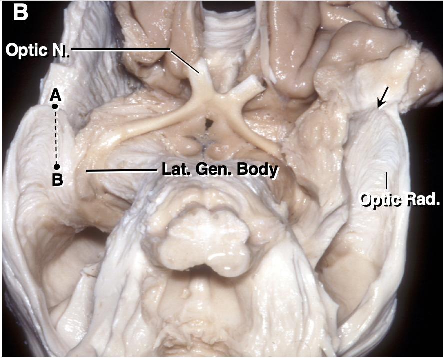 Optic Radiations and the Visual Pathway | Neuroanatomy | The ...