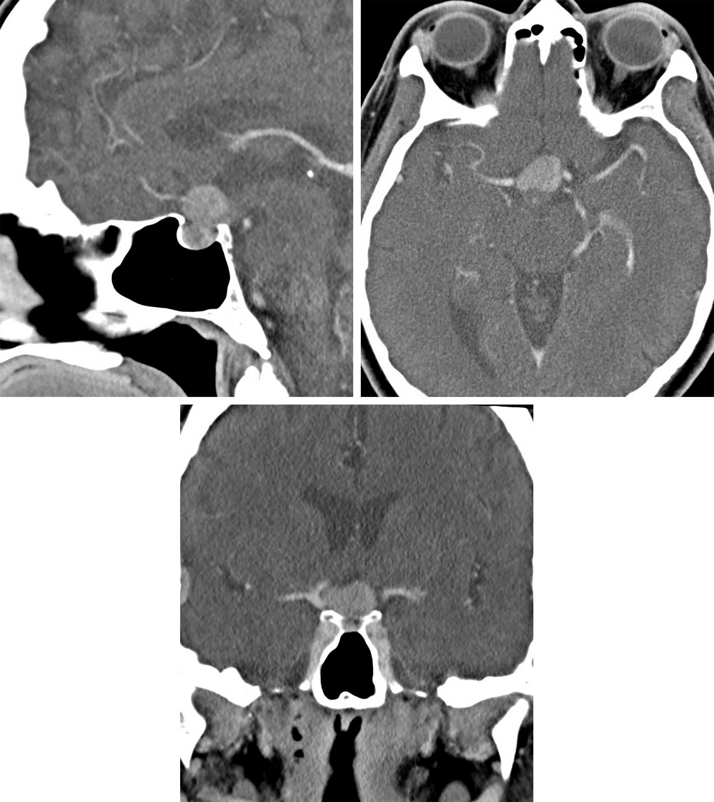 Craniopharyngioma | Cohen Collection | Volumes | The