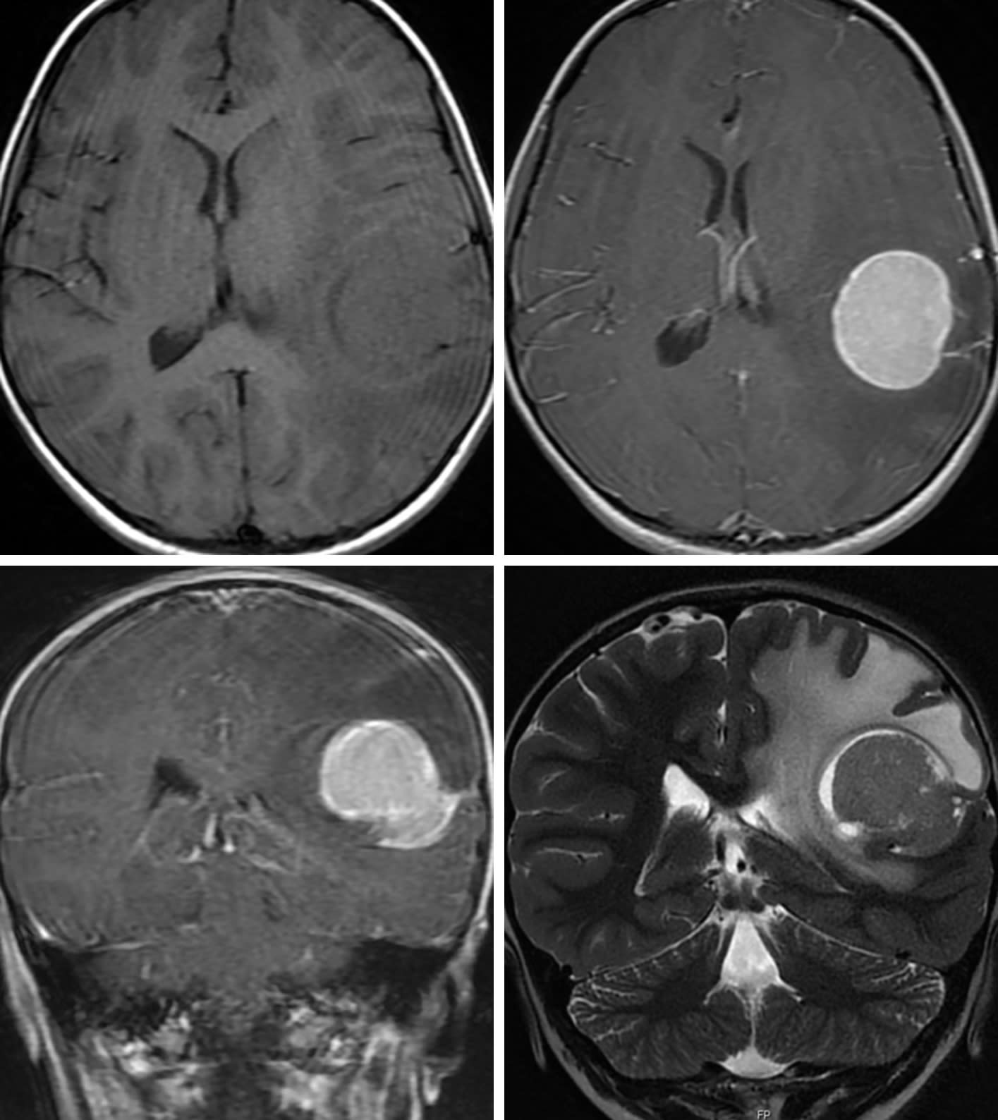 【正規逆輸入品】 Cohen | Xanthoastrocytoma Pleomorphic Collection Volumes | その他