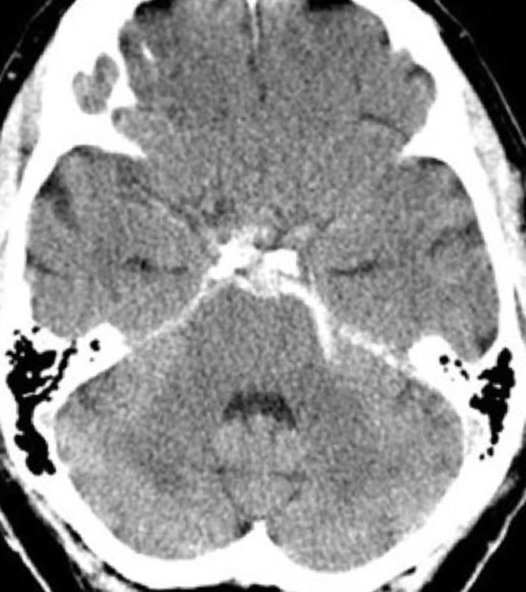 Imaging Evaluation of SAH and Aneurysm | Cohen Collection | Volumes ...