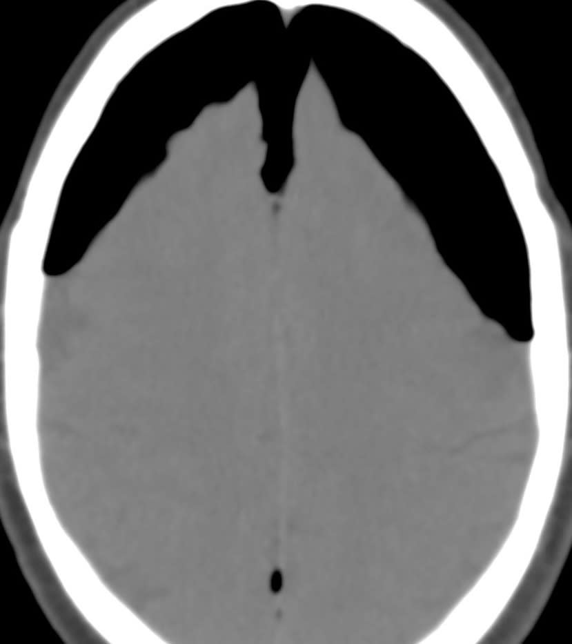 Pneumocephalus | Cohen Collection | Volumes | The