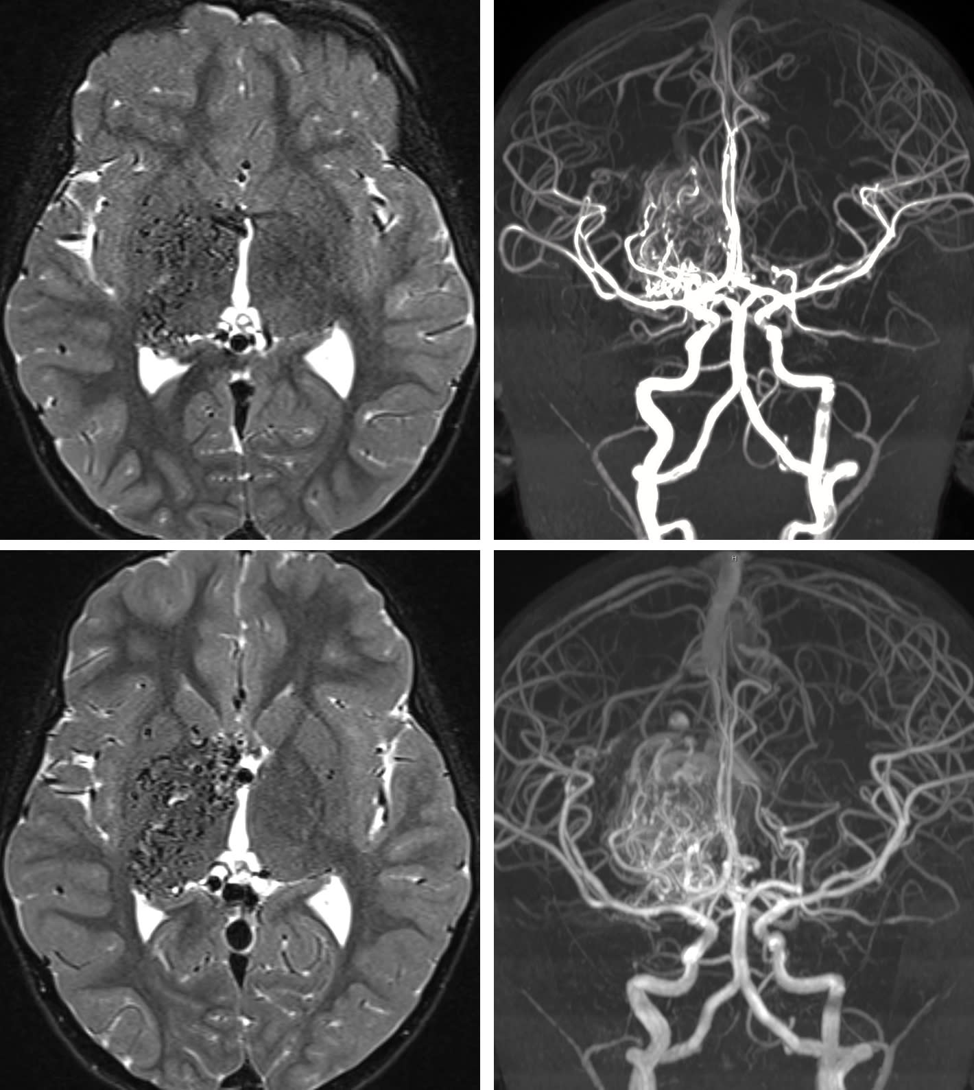 Pediatric AVMs | Cohen Collection | Volumes | The Neurosurgical Atlas