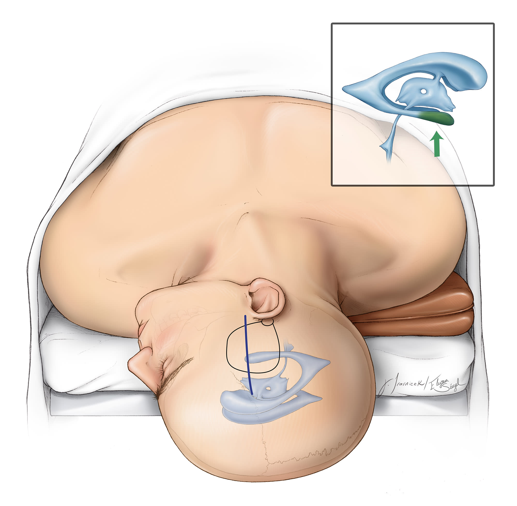 Principles of Intraventricular Surgery | Cohen Collection