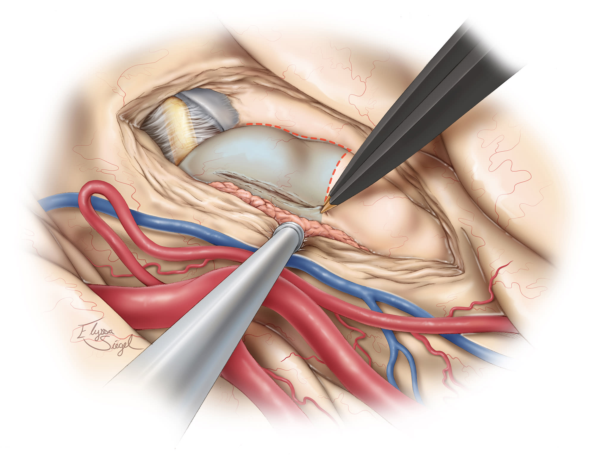 Principles of Intraventricular Surgery | Cohen Collection