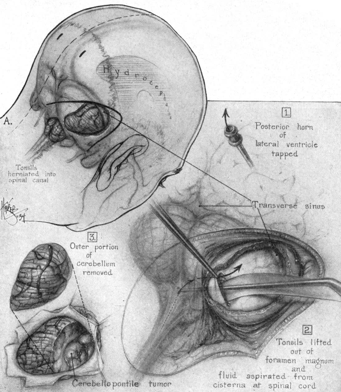 Lessons Learned in Cranial and Skull Base Surgery | Cohen