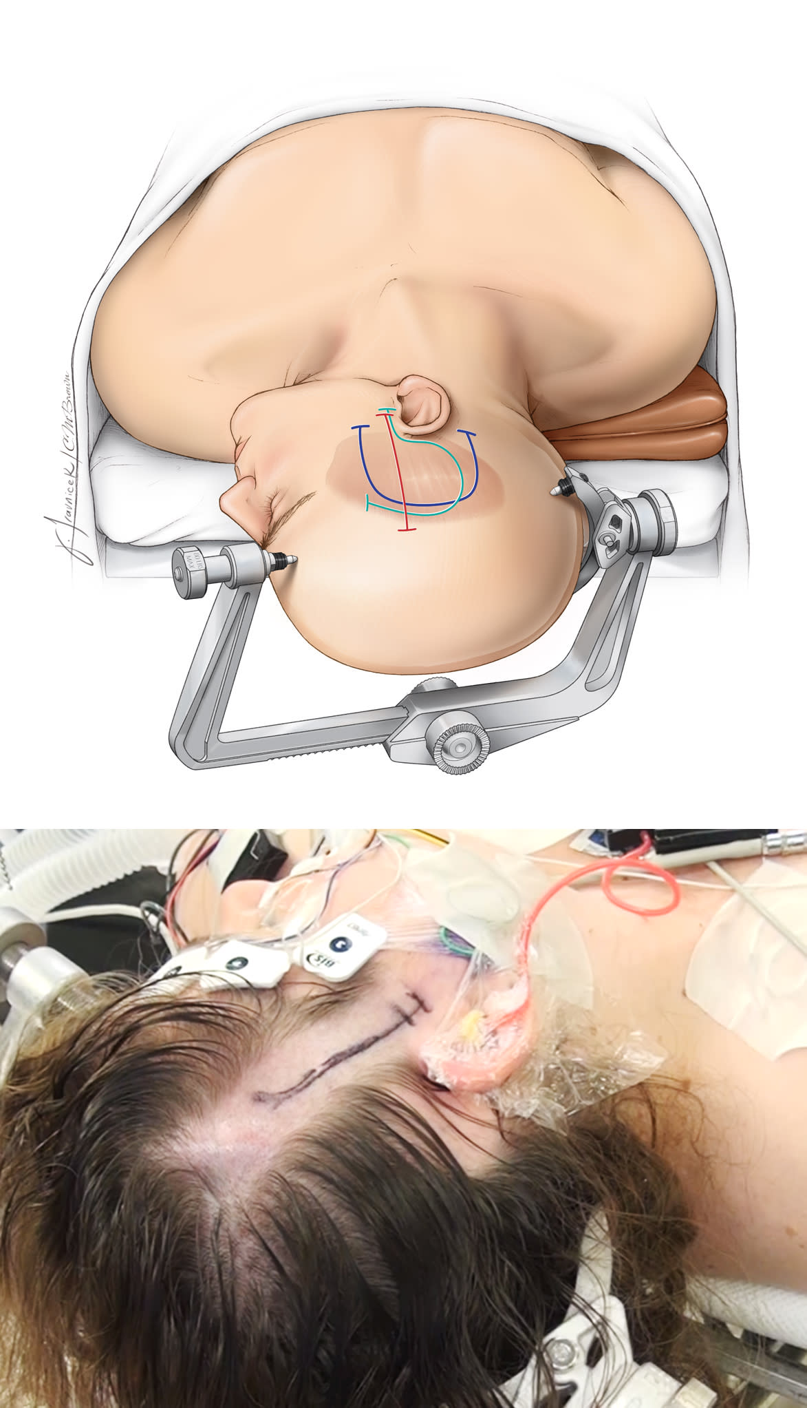 Anterior Petrosectomy | Cohen Collection | Volumes | The