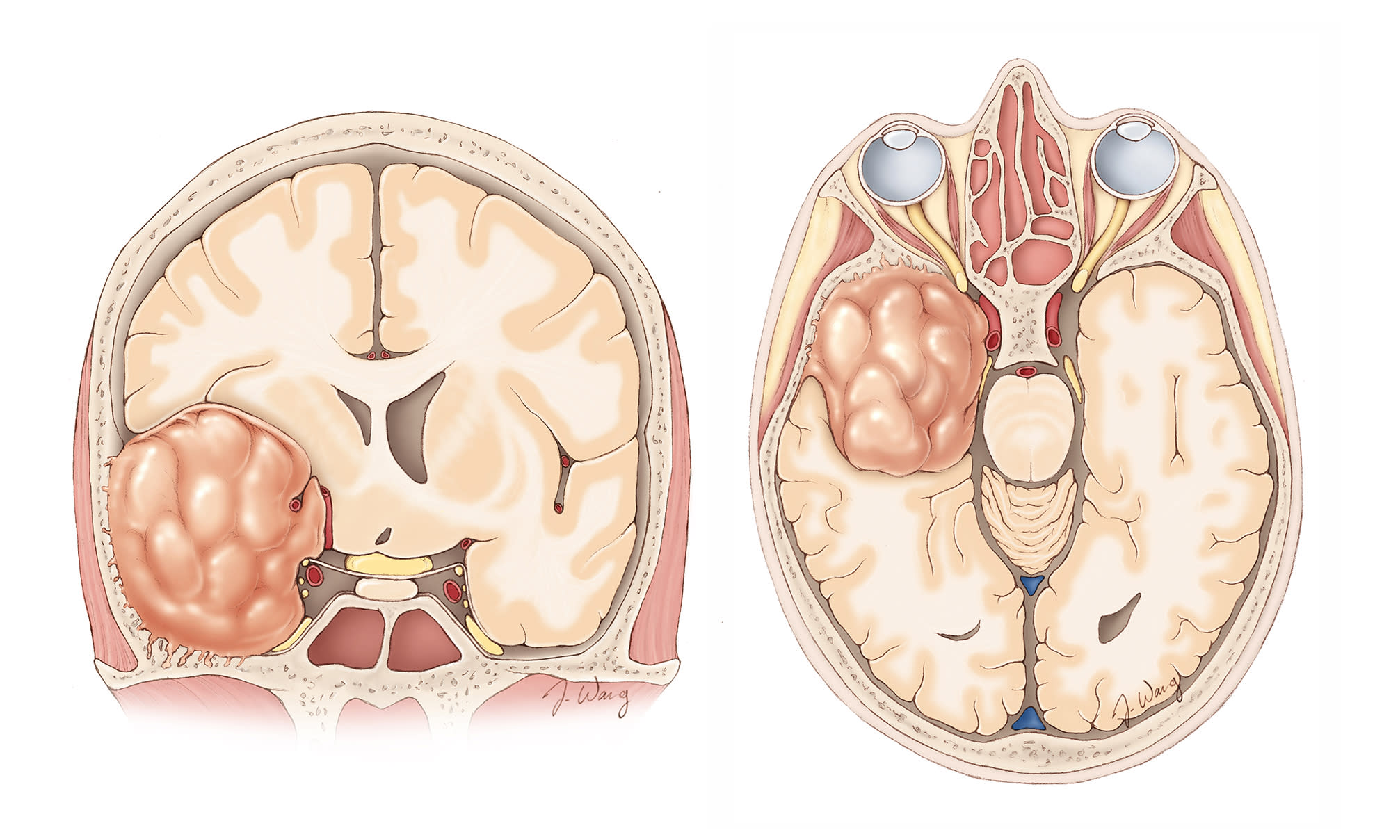 人気ブランドバ40代 Medial Sphenoid Volumes | Collection Cohen | Meningioma Wing 健康・医学