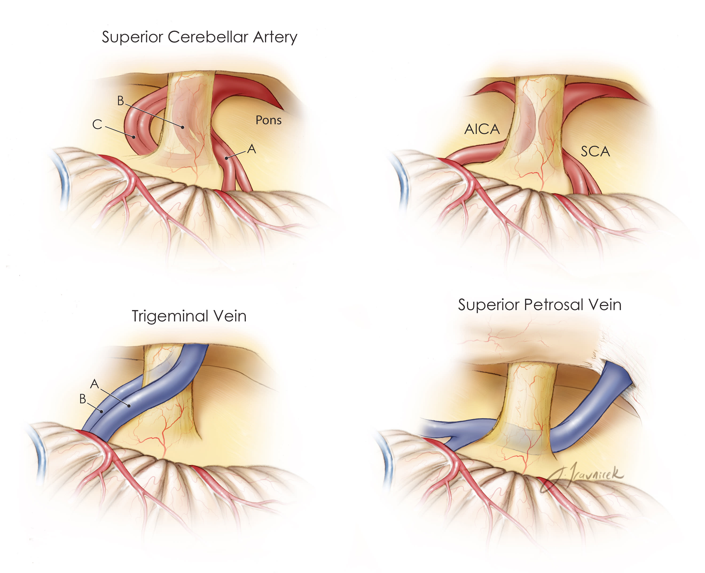 Atlas of Microsurgery of the Lateral S.. 【公式通販】