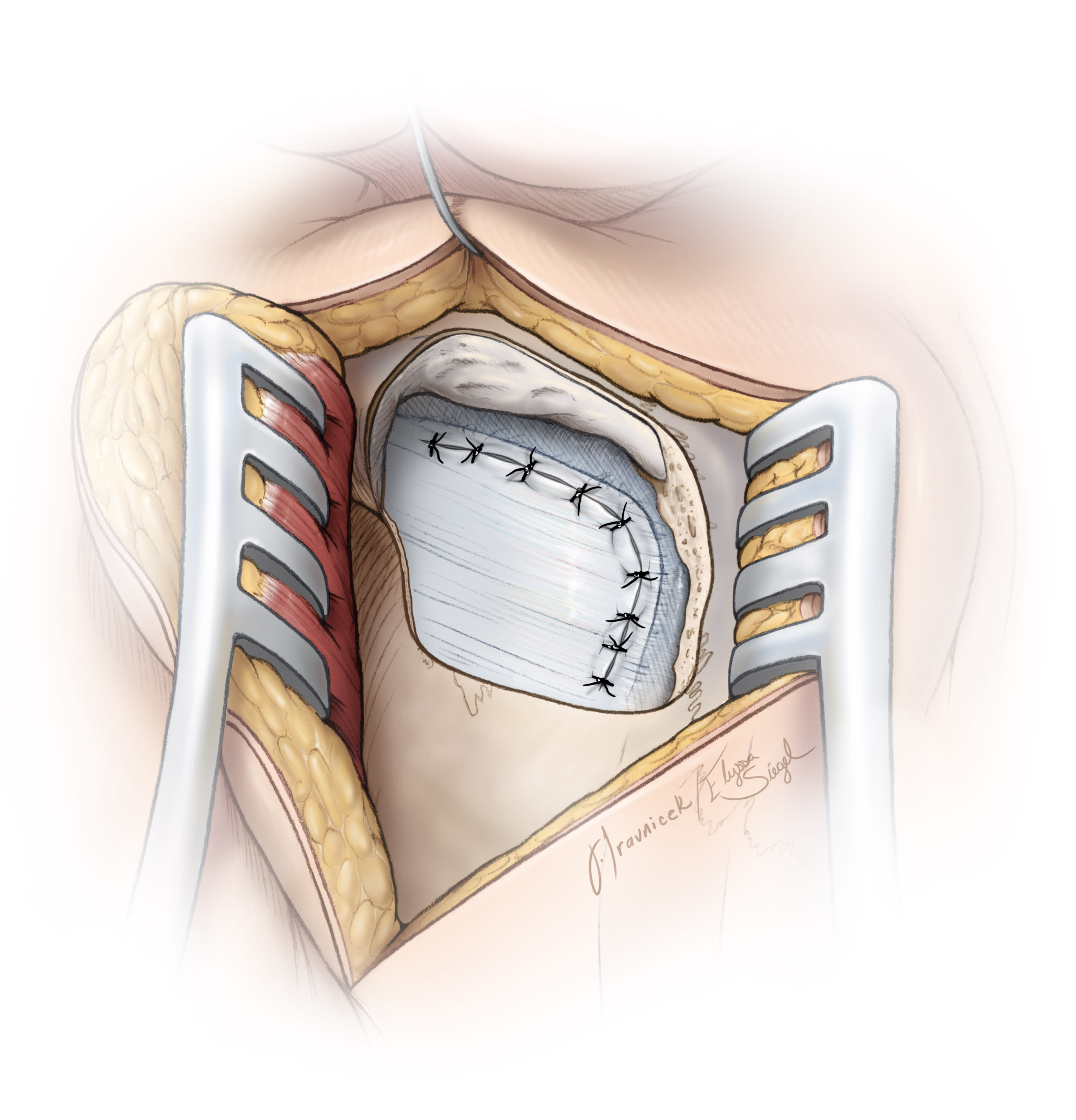 Microvascular Decompression for Trigeminal Neuralgia | Cohen