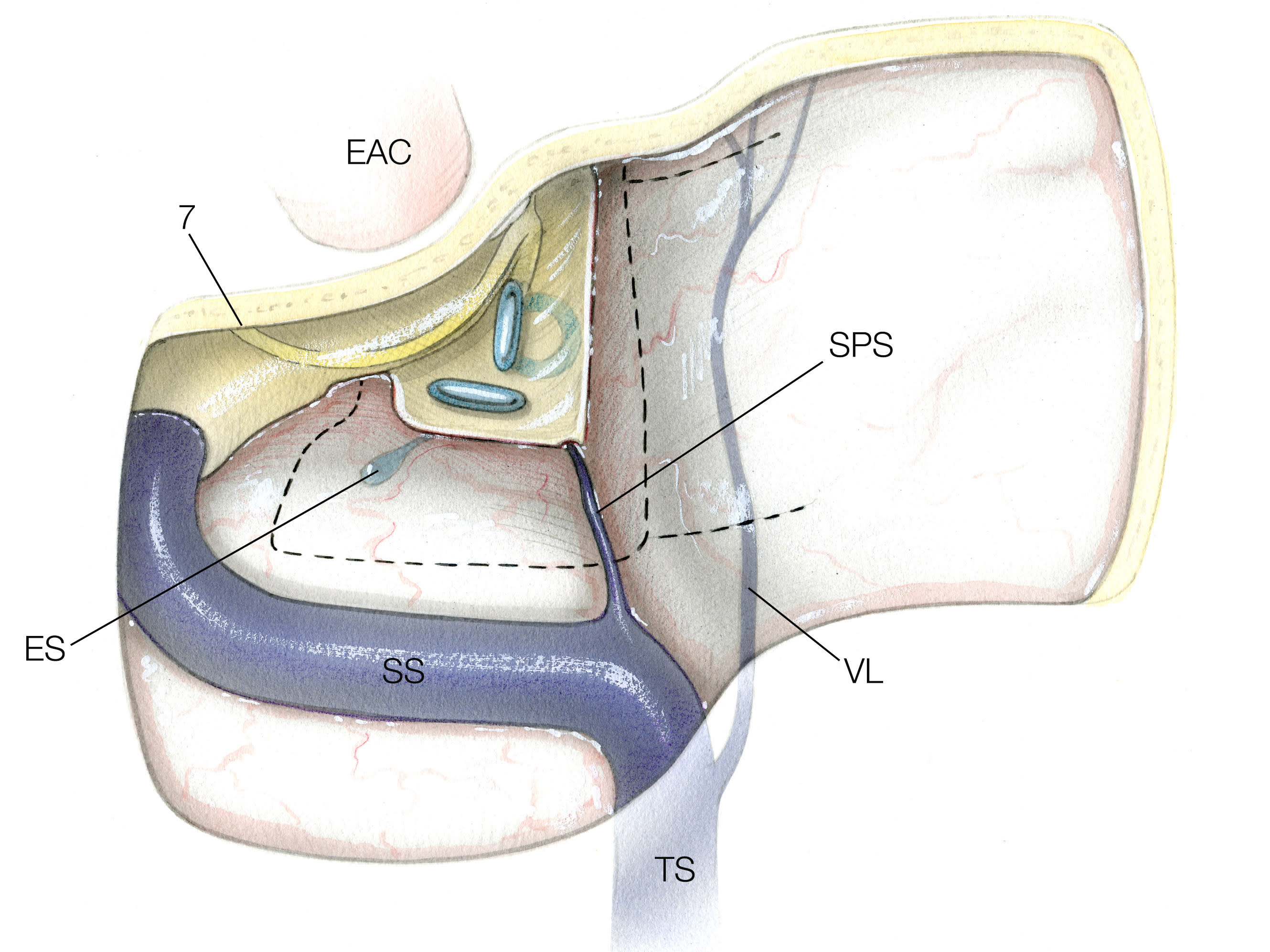 Combined Transpetrosal-Middle Fossa Approaches | Jackler