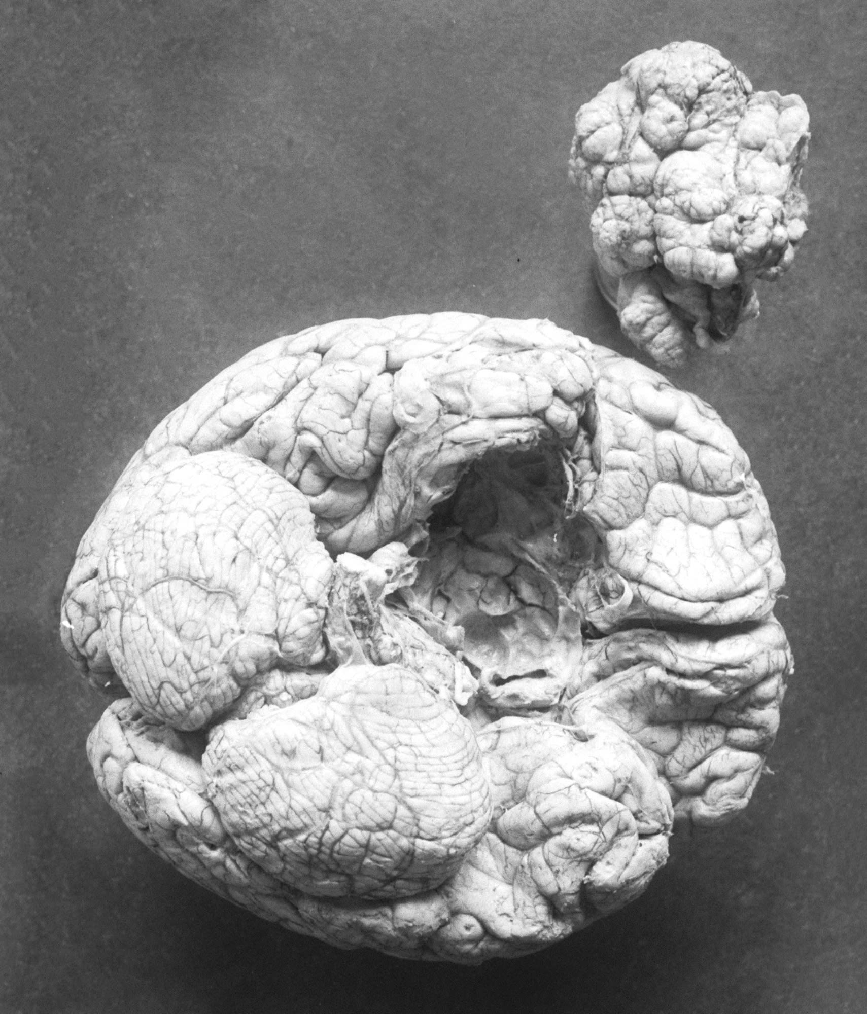 健康・医学 Meningiomas, Part II (Volume 170) i2 健康・医学 Meningiomas, Part II (Volume 170) i2 Meningiomas