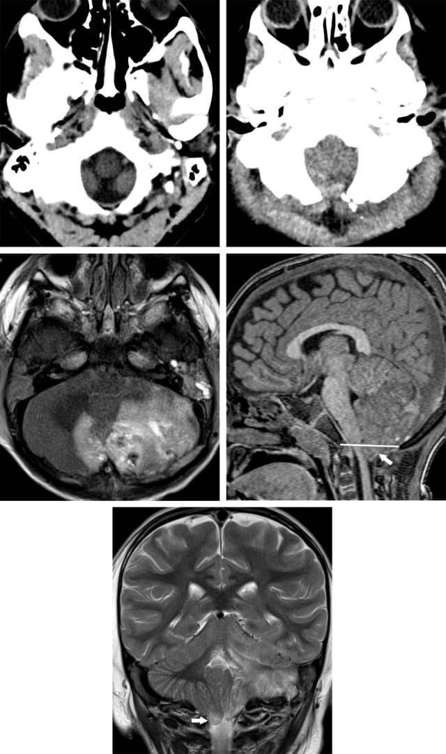 Cerebral Herniation | Cohen Collection | Volumes | The Neurosurgical Atlas