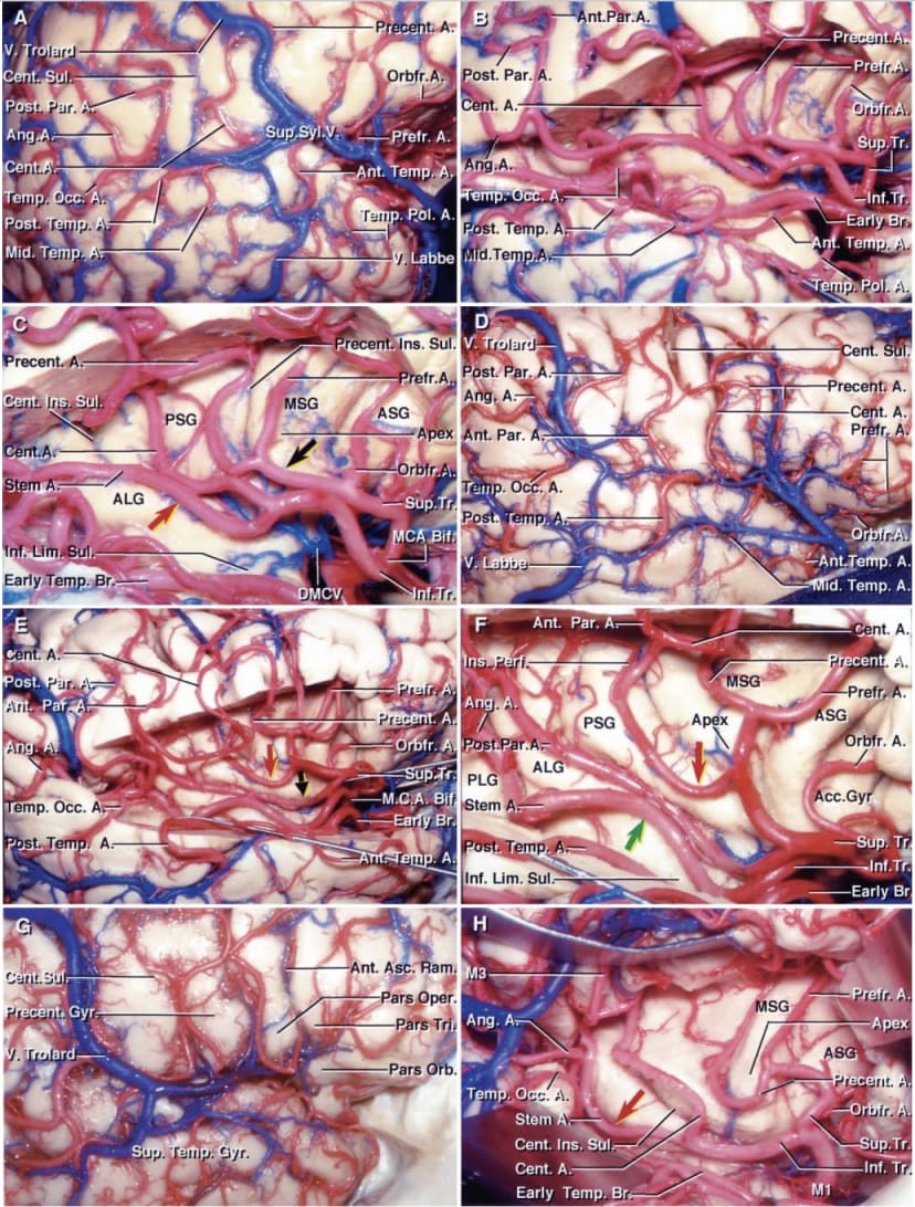 Stepwise Dissections of the Right Insular Region | Neuroanatomy | The ...