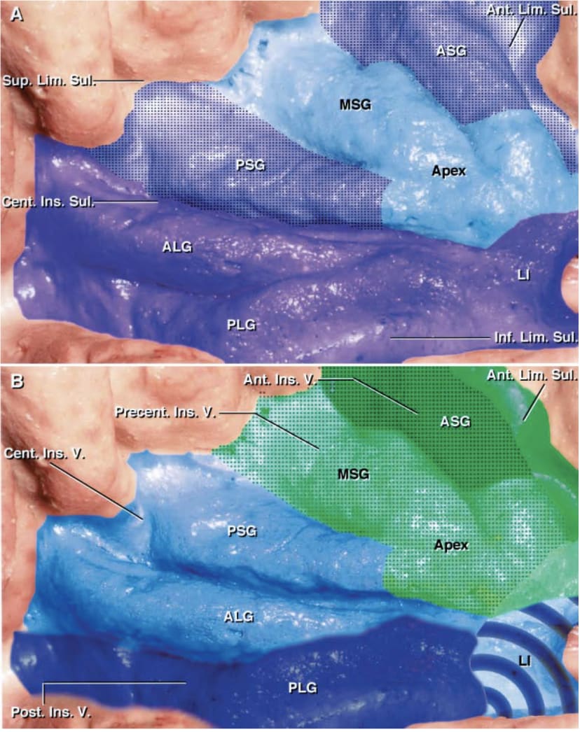 Diagram of the Insular Areas Drained by the Superficial and Deep Venous ...