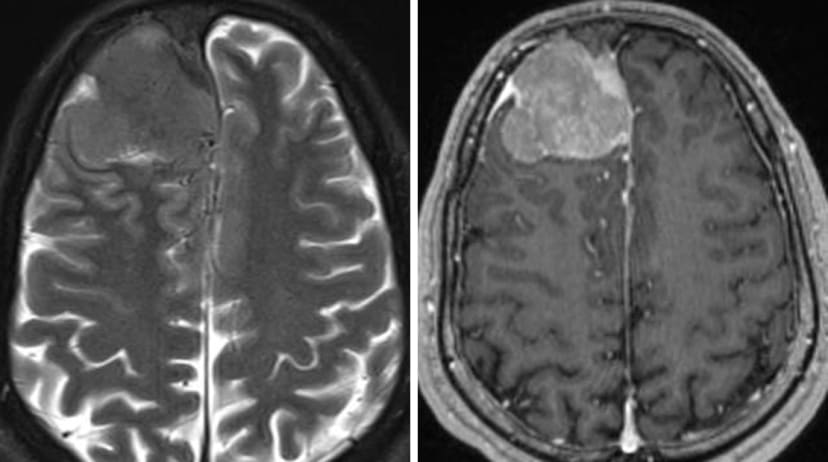 健康・医学 Meningiomas, Part II (Volume 170) i2 健康・医学 Meningiomas, Part II (Volume 170) i2 Meningiomas