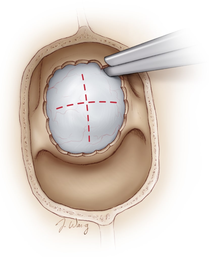 Microscope-Guided Endonasal Transsphenoidal Approach | Cohen Collection ...