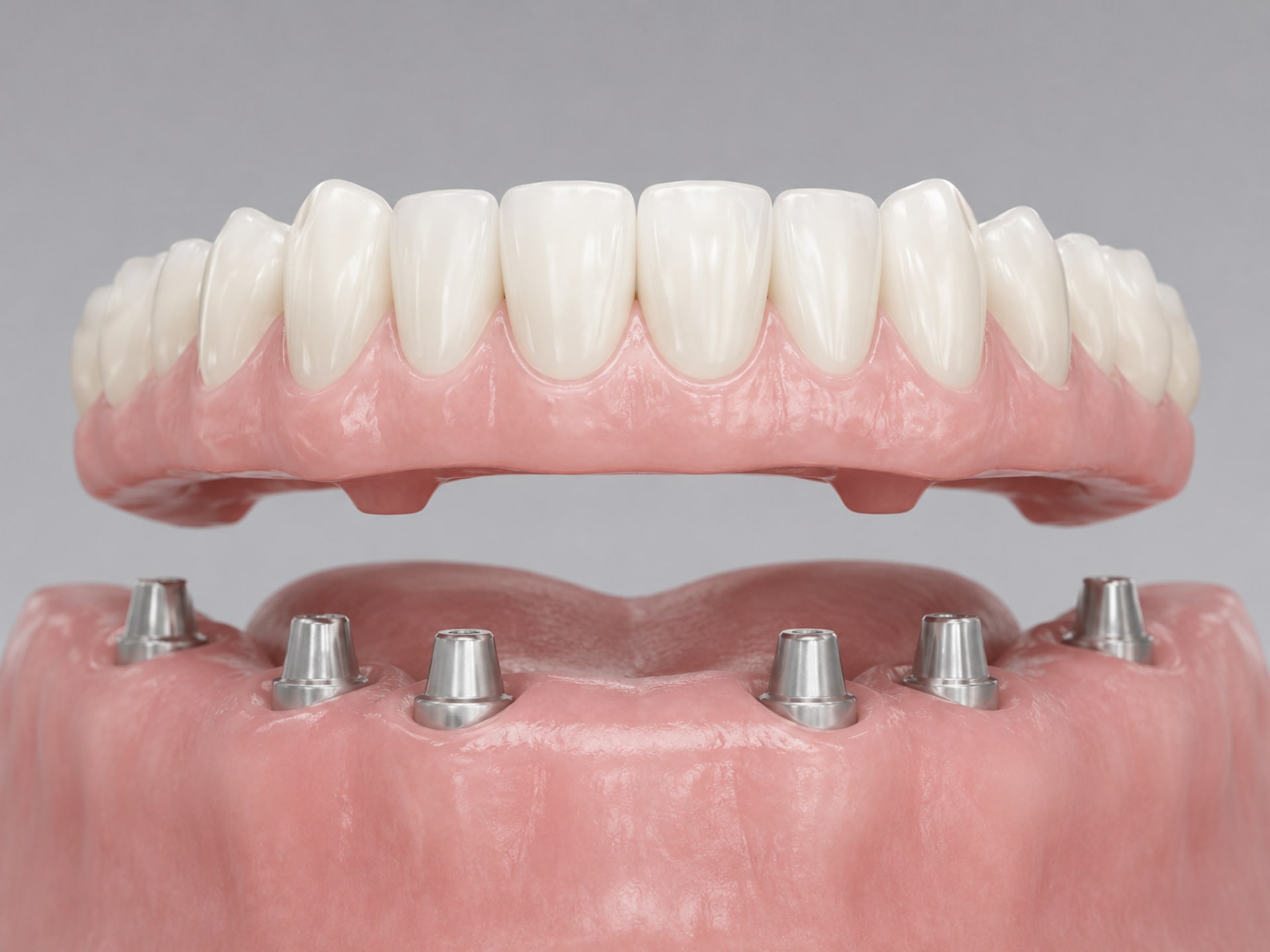 All-on-4 Dental Implants in Glen Waverley