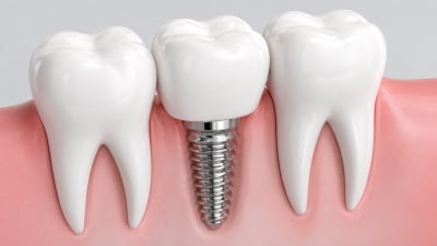 Dental Implants