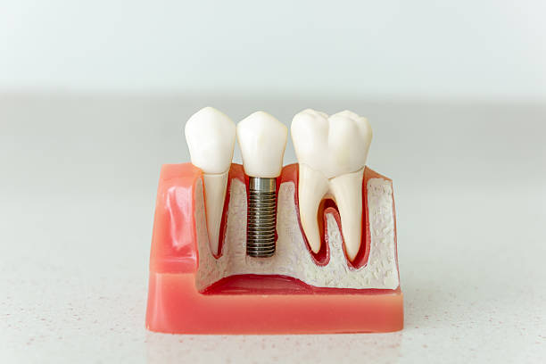 Dental Implants
