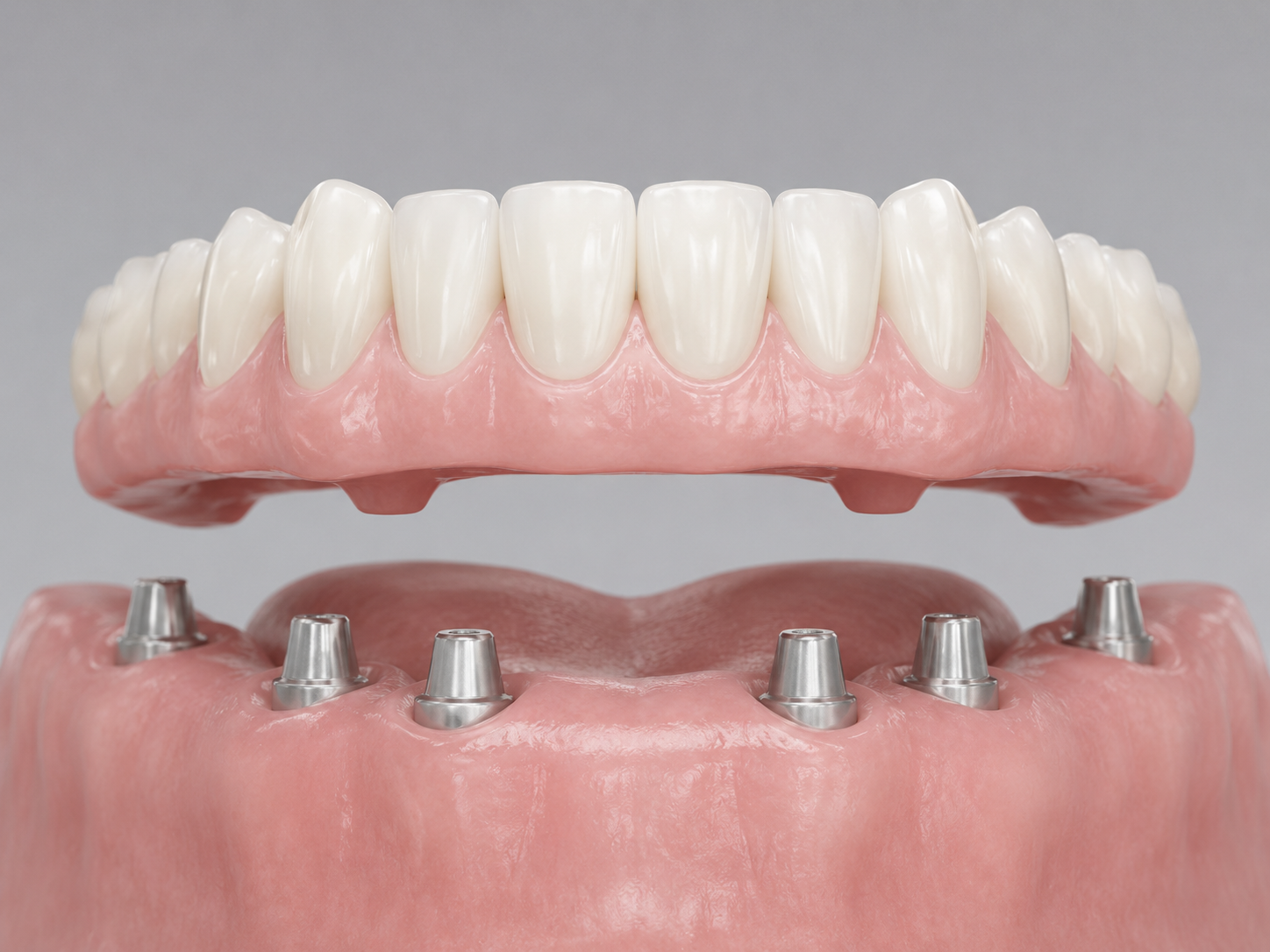 All-on-4 Dental Implants in Glen Waverley