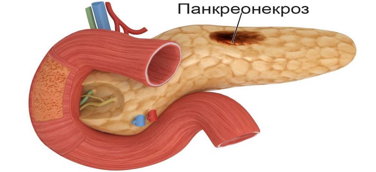 Стерильный панкреонекроз