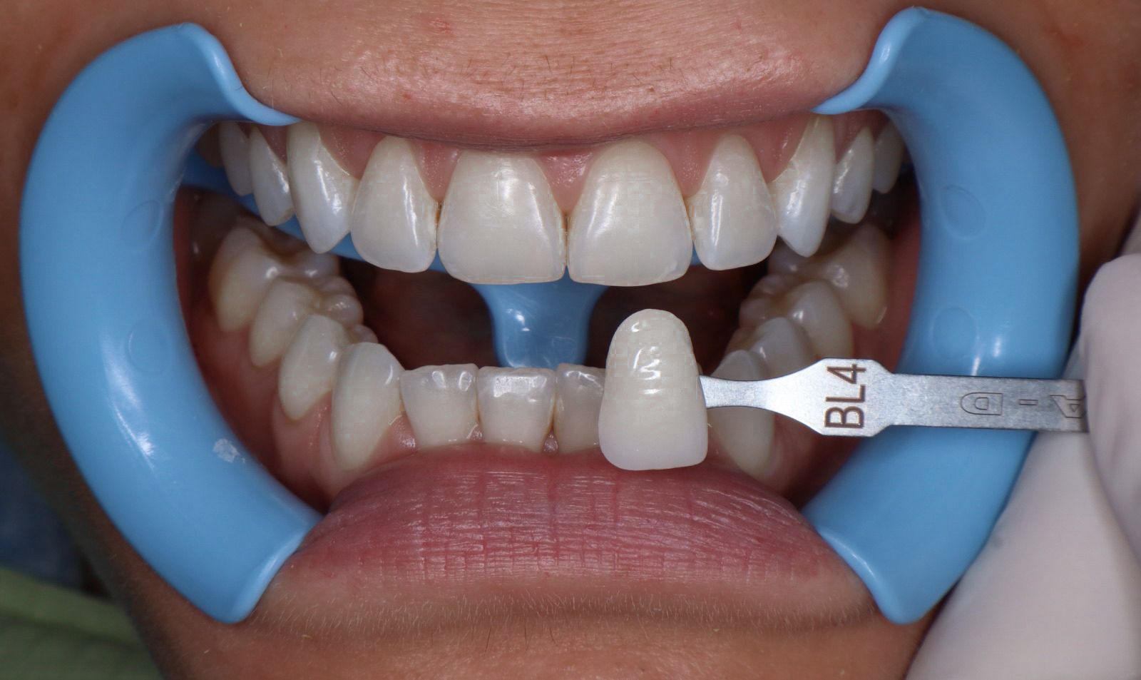 Procedimiento dental digital